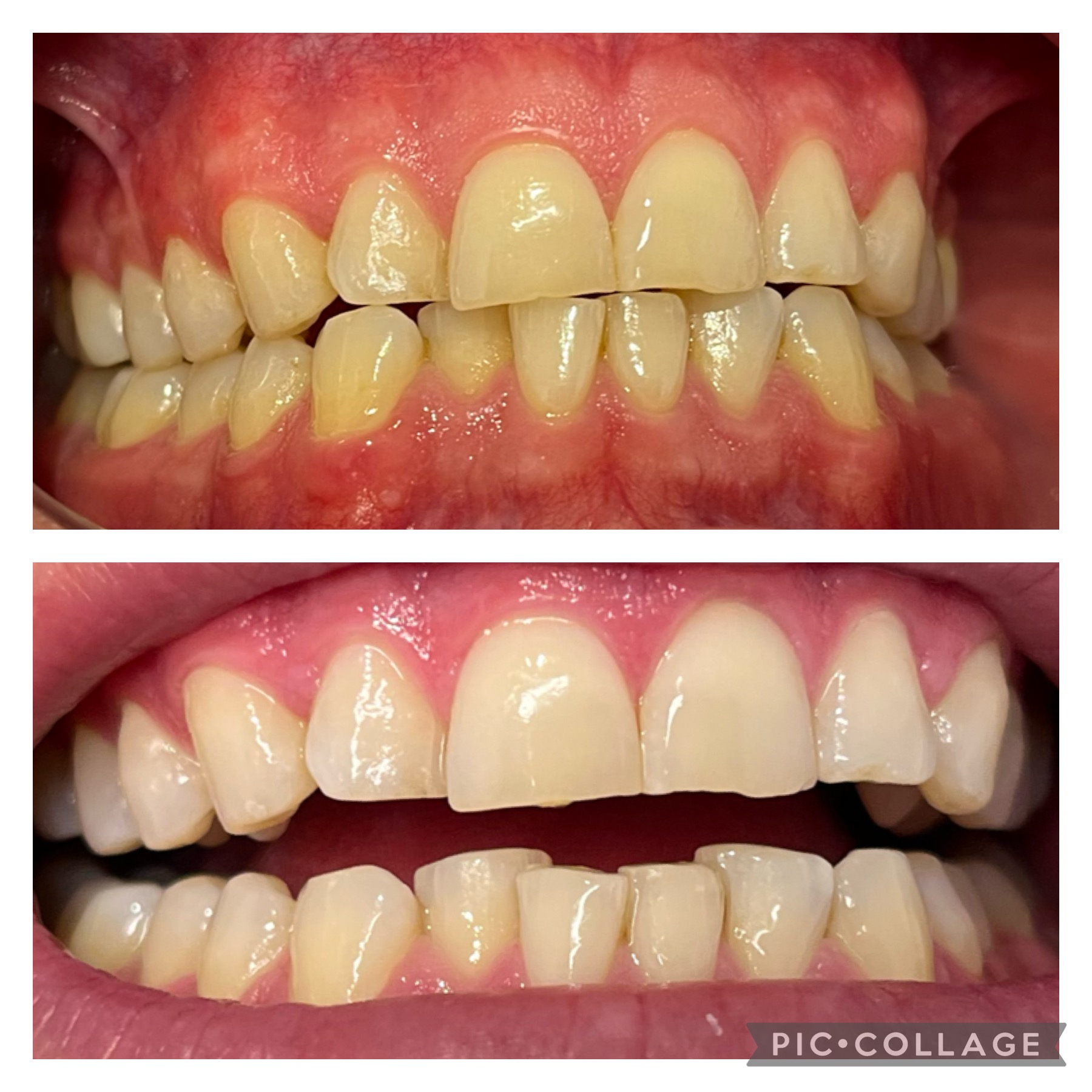 Before and after teeth whitening result 4 — 8 shades whiter
