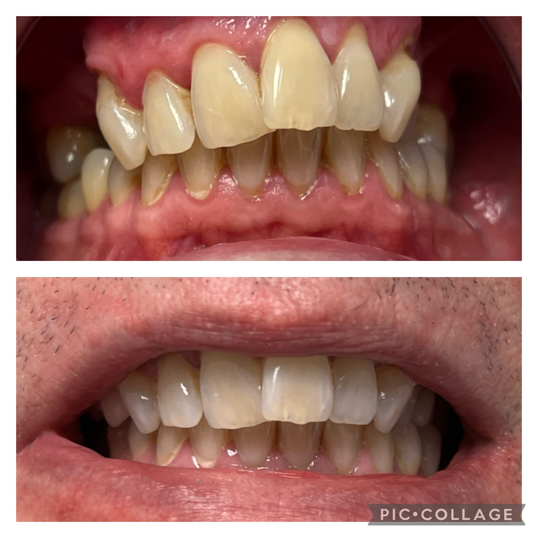 Before and after teeth whitening result 5 — 6 shades whiter